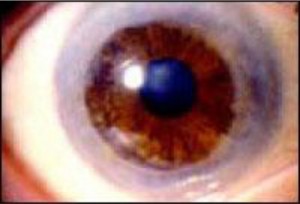 kerotoeidis-metamosxeusi